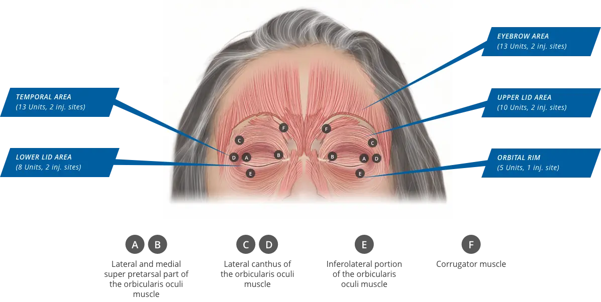 XEOMIN dosing and admin instructions for adults with blepharospasm